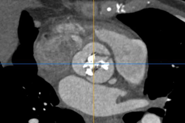 Cardiac CT course Rotterdam Erasmus CT cursus